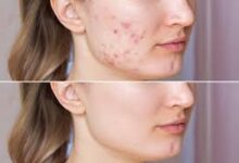 Acne Treatment in Kolkata