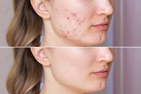 Acne Treatment in Kolkata
