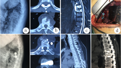 Best Endoscopic Spine Surgeon in Kerala