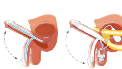 Malleable Penile Prosthesis Surgery in India