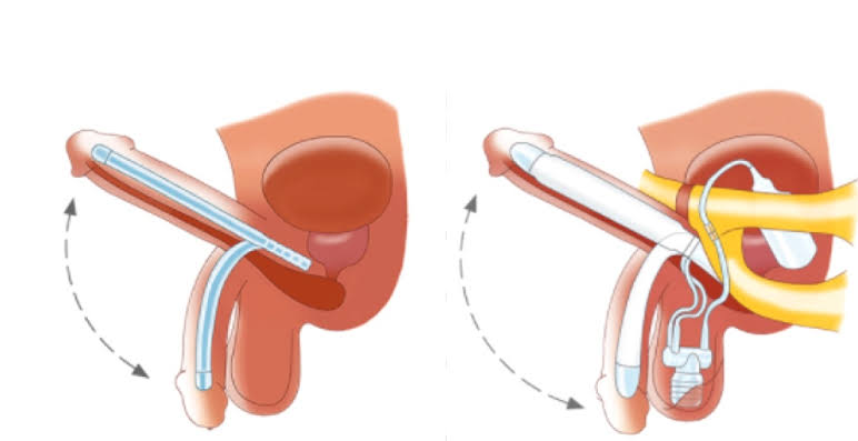 Malleable Penile Prosthesis Surgery in India